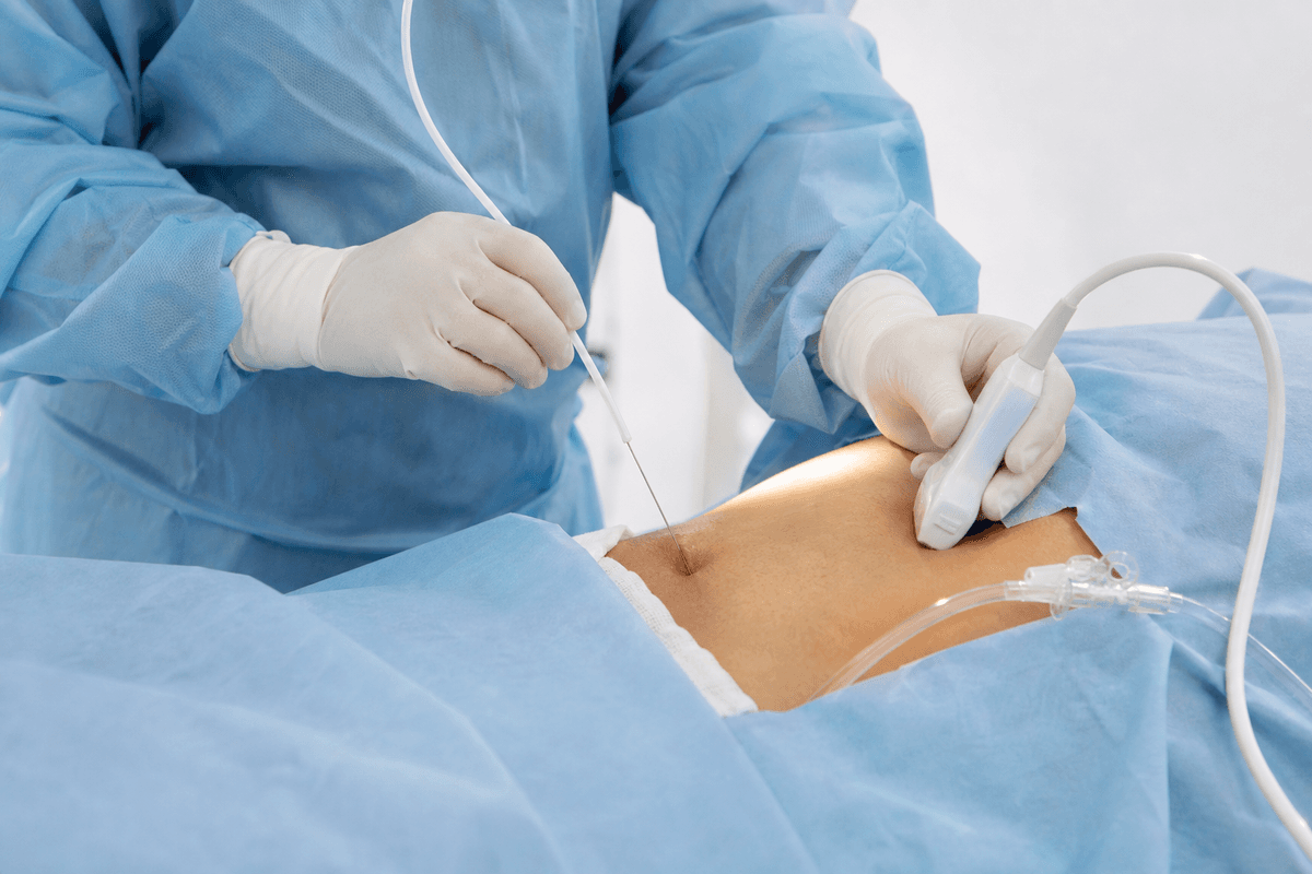 CAPD Catheter Insertion