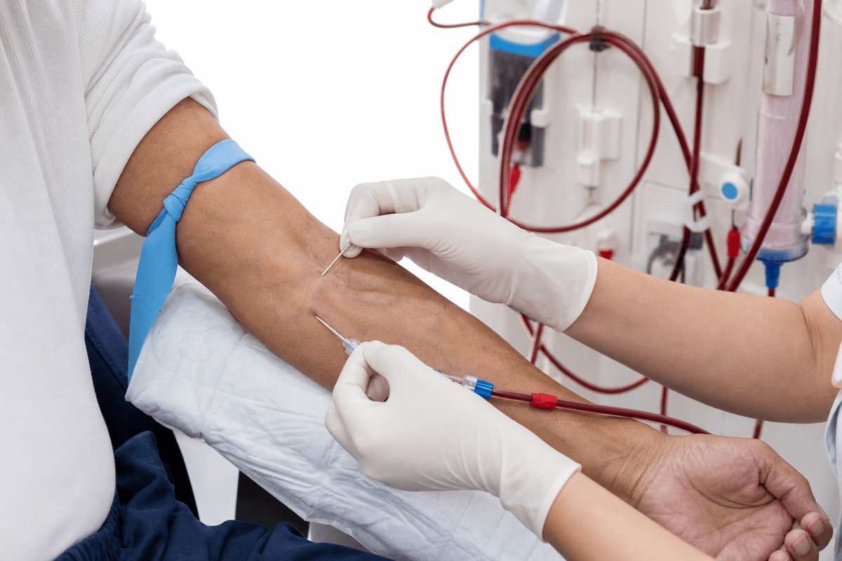 AVF Cannulation